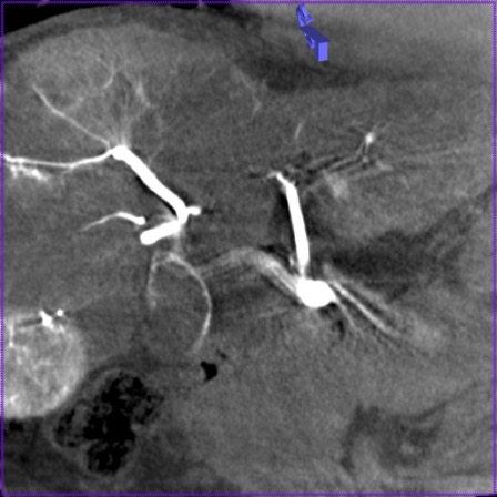 Пример, демонстрирующий артефакты движения
