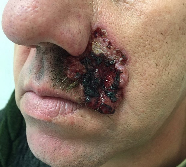 инфильтративную