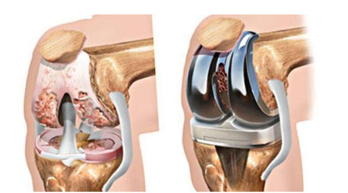 Рис. 5. Тотальное эндопротезирование коленного сустава состоит из трех компонентов: бедренного, большеберцового и надколенникового Рис. 5. Тотальное эндопротезирование коленного сустава состоит из трех компонентов: бедренного, большеберцового и надколенникового