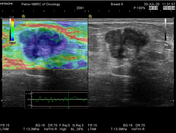 Рис.11 Эластограмма жесткого образования – рака молочной железы