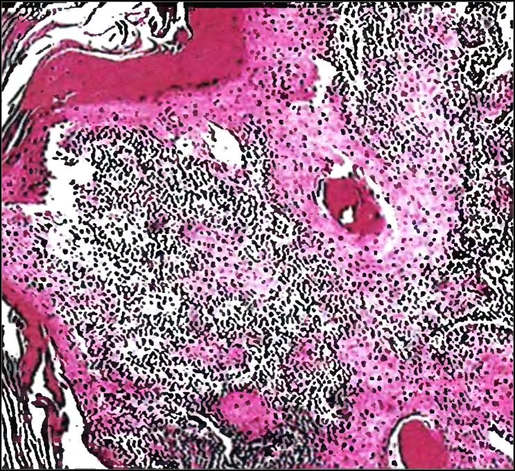 Плоскоклеточный высокодифференцированный рак