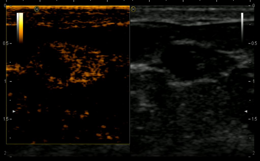 Рис.12 Ультразвуковое исследование с контрастированием: папиллома молочной железы