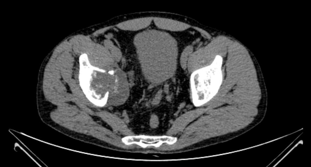 КТхондросаркома