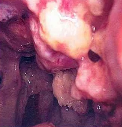 Мезатилиома плевры. Торакоскопия