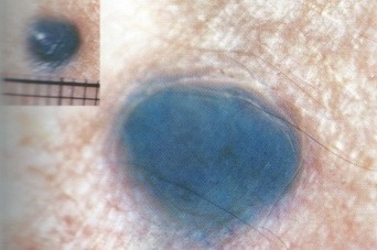 Голубой невус