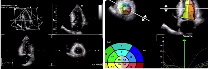 Измерение ФВ ЛЖ в 3D режиме