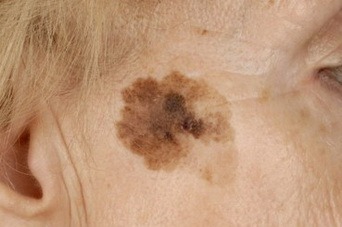 Внутридермальный