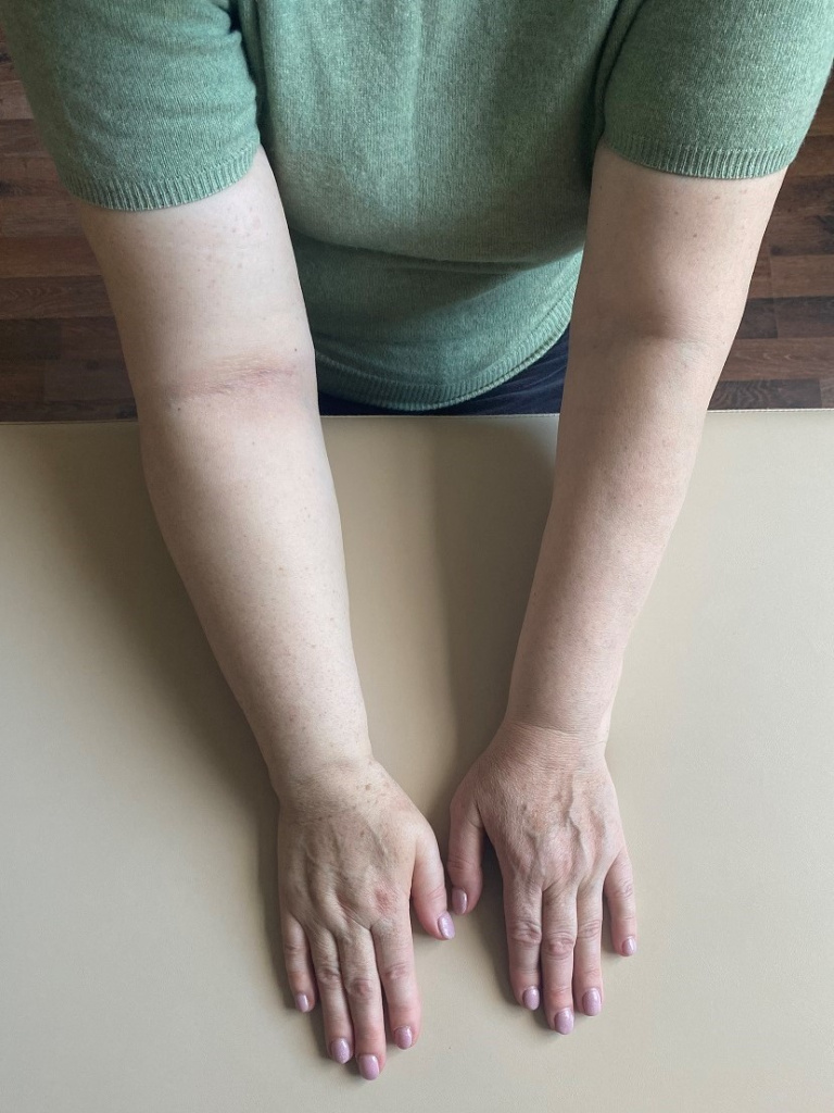 Лимфедема лечение Лимфедема лечение