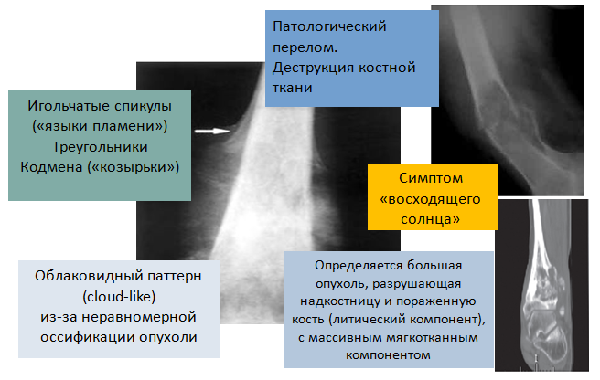 Рис. 2. Рентгенологические признаки остеогенной саркомы Рис. 2. Рентгенологические признаки остеогенной саркомы