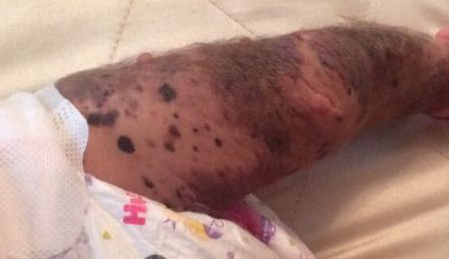 Врожденный гигантский меланоцитарный невус