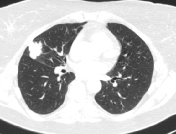 Рак легкого