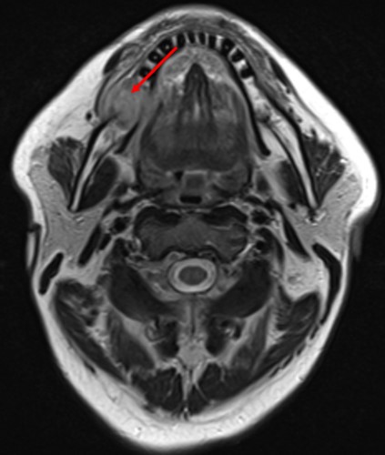 Рис.3 МРТ с внутривенным контрастированием Рис.3 МРТ с внутривенным контрастированием