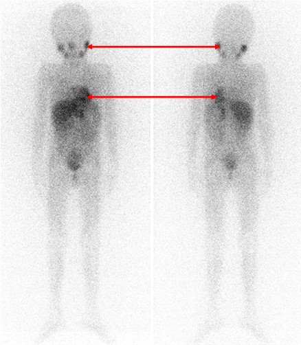 Рис. 7. Сцинтиграфия с метайодбензилгуанидином (визуализируется первичная паравертебральная опухоль с метастазами в кости черепа)