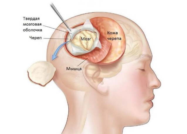Схематичное изображение доступа к опухоли посредством трепанации черепа при оперативном вмешательстве Схематичное изображение доступа к опухоли посредством трепанации черепа при оперативном вмешательстве