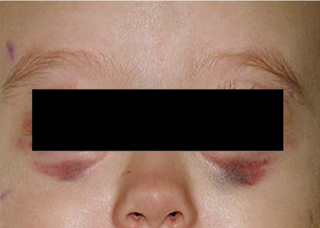 Рис. 3.1. Симптом «очков»