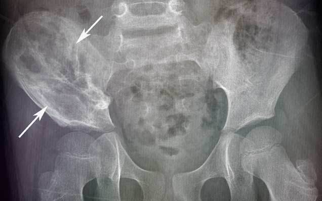 Саркома Юинга подвздошной кости Саркома Юинга подвздошной кости