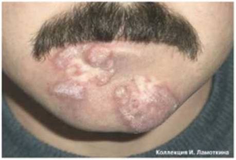 кератоз предраковый