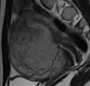 Рис. 2 Эндометриальная стромальная саркома матки низкой степени злокачественности Рис. 2 Эндометриальная стромальная саркома матки низкой степени злокачественности