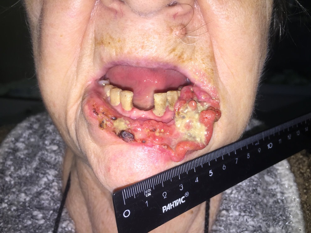 Фото рака губы