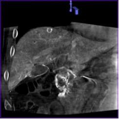 Пример, демонстрирующий выраженные артефакты движения