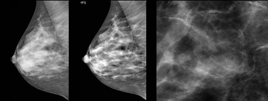 Рак молочной железы