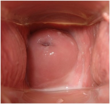 Нормальная шейка матки