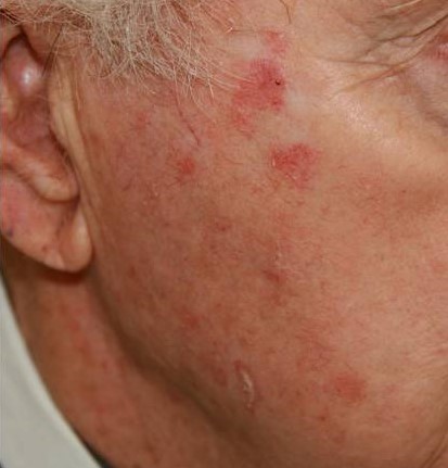 актинический кератоз