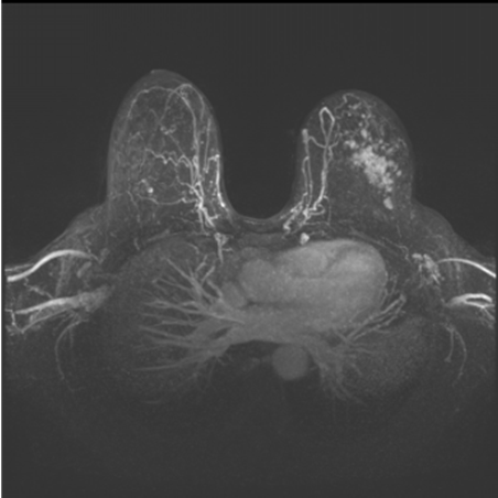 Рис.13 МР-томограмма рака молочной железы