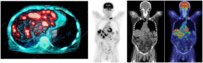 Позитронно-эмиссионная томография Позитронно-эмиссионная томография