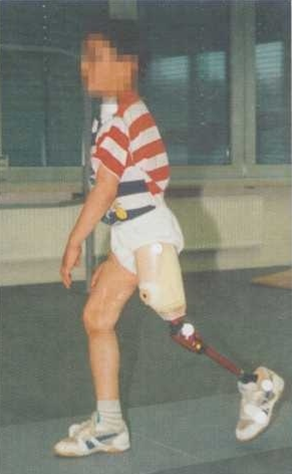 Рис.9 Экзопротезирование нижней конечности Рис.9 Экзопротезирование нижней конечности